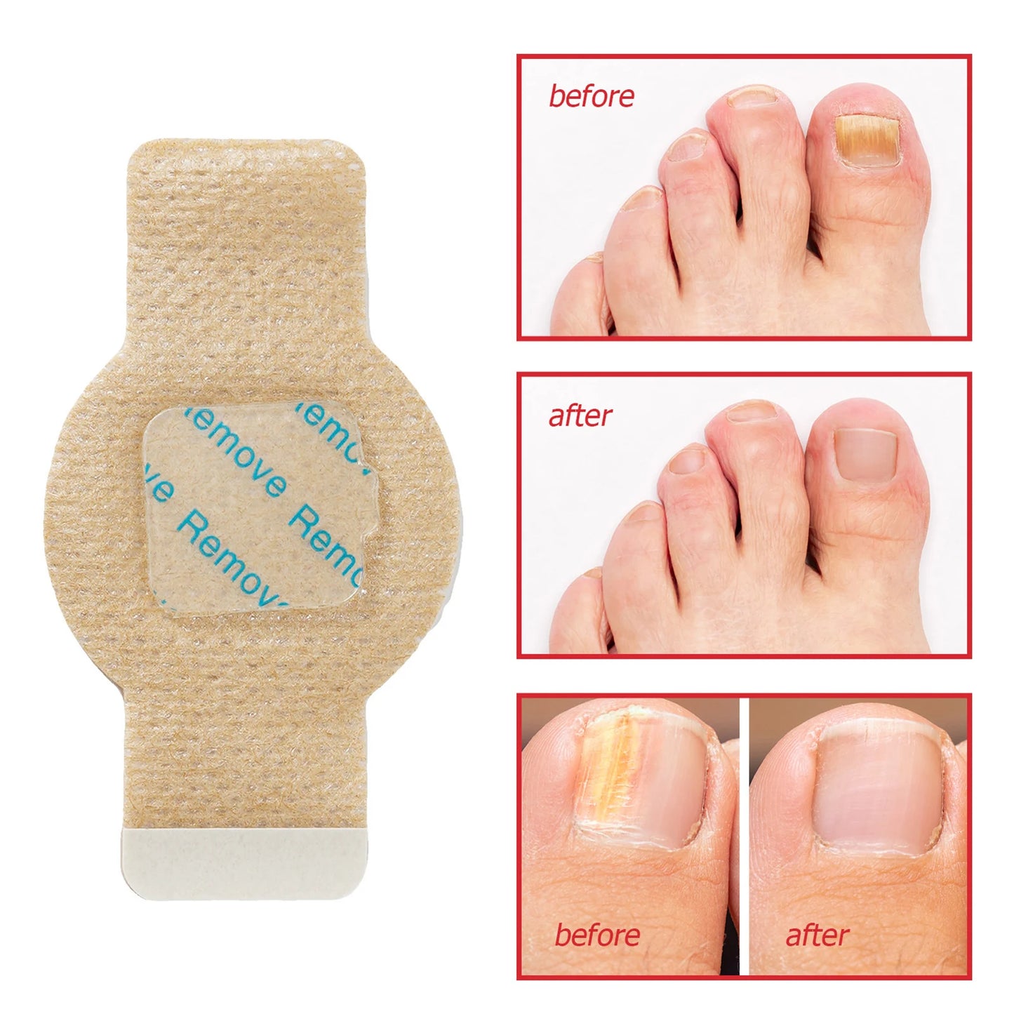 Toenail Fungus Treatment Extra Strength Patches Night-Time Treatment Improves Nail Appearance for Damaged Nails Foot Nails