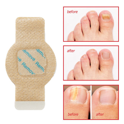 Toenail Fungus Treatment Extra Strength Patches Night-Time Treatment Improves Nail Appearance for Damaged Nails Foot Nails